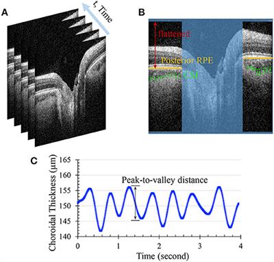 Non-invasive Clinical Measurement of Ocular Rigidity and Comparison to Biomechanical and Morphological Parameters in Glaucomatous and Healthy Subjects